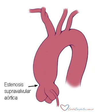 Est-supravalv-ao-anatomia