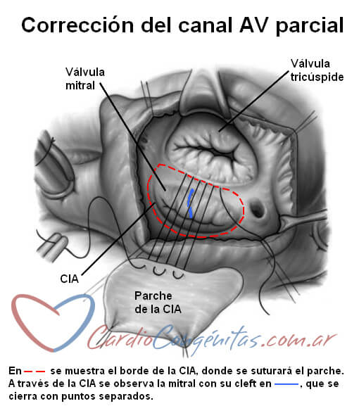 Cirugia-canal-parcial
