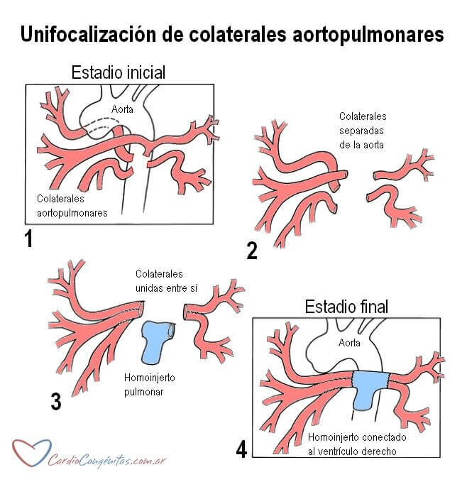 Focalizacion-en-AP-con-CIV-y-colaterales