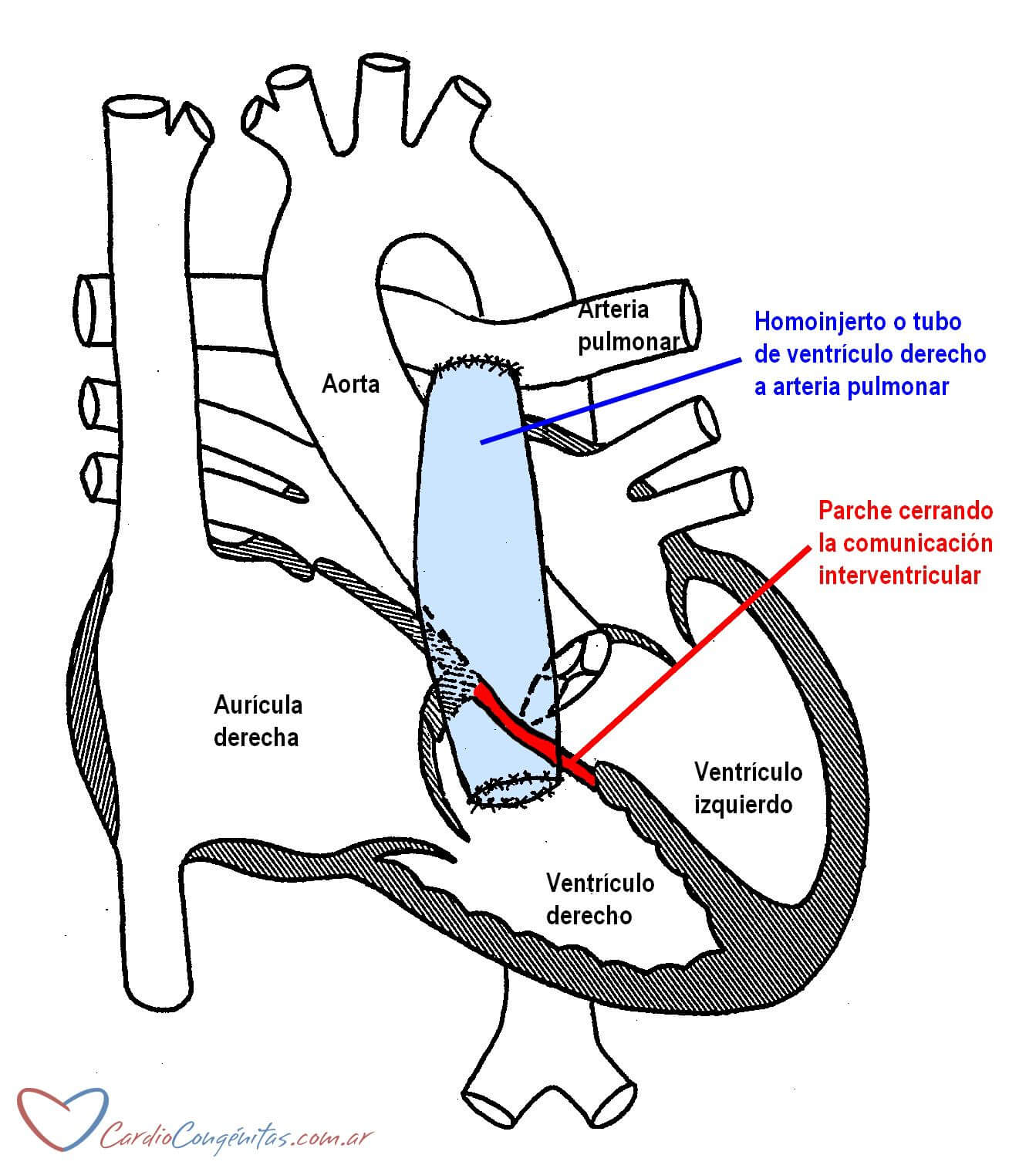 Tubo-de-VD-a-AP