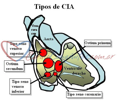 Tipos-de-CIA