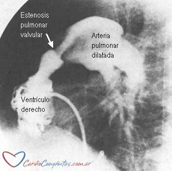 EP-valvular-cateterismo