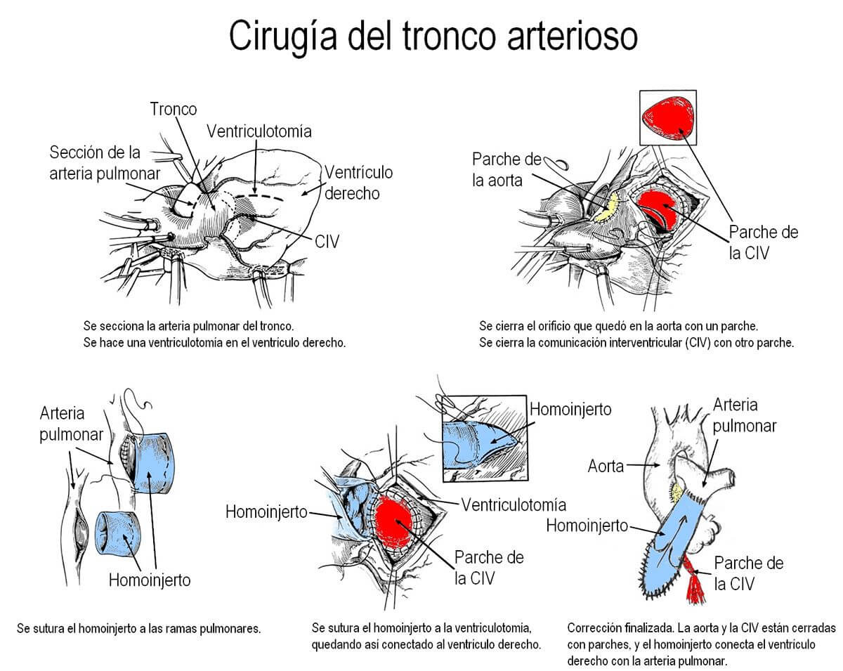 Tronco-cirugia