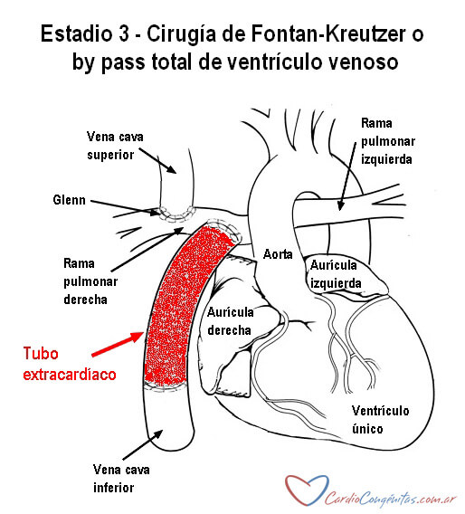 Fontan